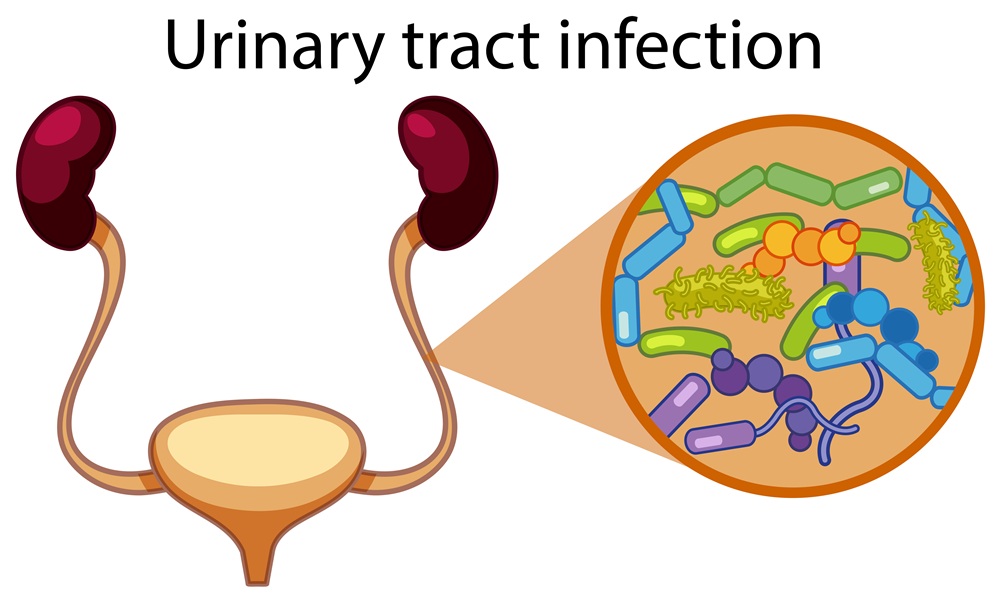 Urinary Tract Infection (UTI): Symptoms, Causes & Effective Treatment