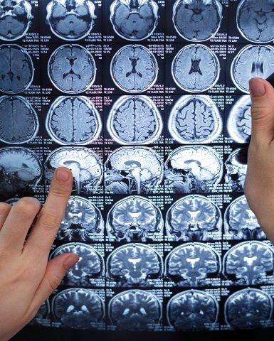 Neurology